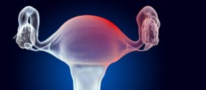 Miyom Ameliyatı Sonrası Tüp Bebek Ne Zaman Yapılır?