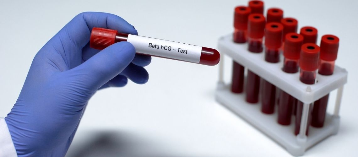 HCG Nedir Beta HCG Degerleri Ne Anlama Gelir HCG Nedir? Beta HCG Değerleri Ne Anlama Gelir?