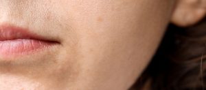 Asiri Tuylenme Hirsutizm Nedir Belirtileri ve Tedavisi Aşırı Tüylenme (Hirsutizm) Nedir? Belirtileri ve Tedavisi