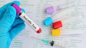 Anti HIV I – II Seroloji Testleri