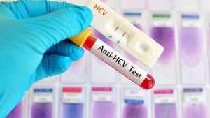 Anti – HCV Seroloji Testleri