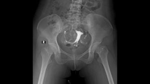 Histerosalpingografi HSGrahim filmi Testler